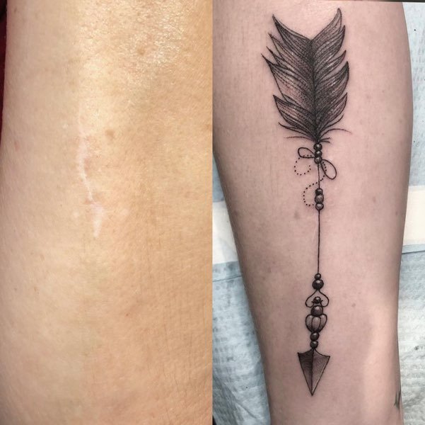 Scar Coverups Using Tattoos